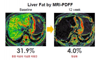 MRI-PDFF 검사 전후 비교